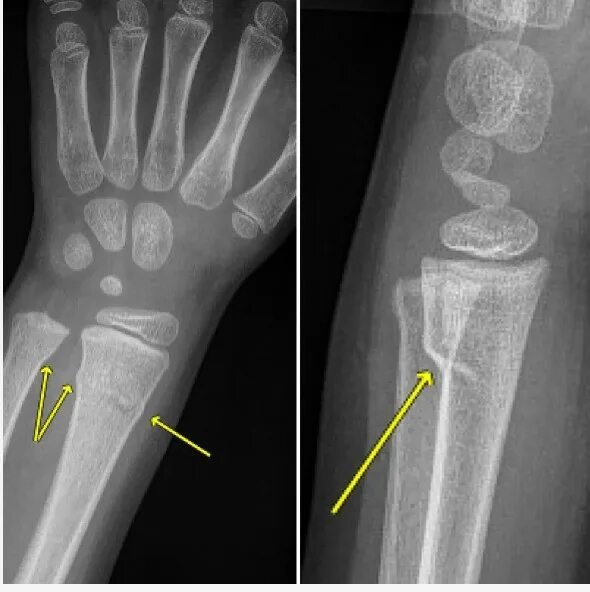 Трещина лучевой кости руки. Костное образование на месте перелома. Перелом лучевой кости ноги.