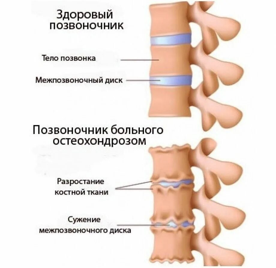 Остеохондроз поясничного отделения позвоночника. Остеохондроз грудного поясничного отдела позвонка. Остеохондроз грудного отдела позвоночника симптомы. Остеохондроз грудного отдела грудной отдел.