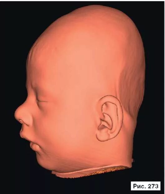 непрерывные соединения черепа. скафоцефалия сагиттальный шов. расхождение костей черепа. краниостеноз тригоноцефалия операция. срастание костей черепа.