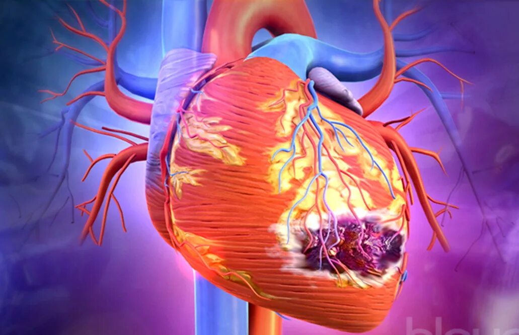 Безболевой инфаркт миокарда. Здоровое сердце и инфаркт миокарда. Сердечно сосудистая система инфаркт.