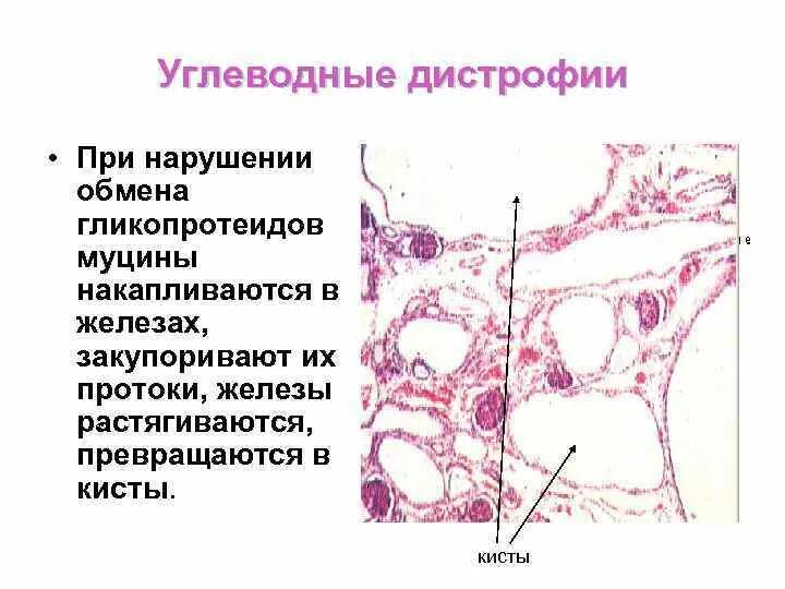 Паренхиматозные углеводные дистрофии. Паренхиматозная жировая дистрофия почек. Паренхиматозные углеводные дистрофия почек. Мезенхимальная углеводная дистрофия. Углеводная дистрофия микроскопические.