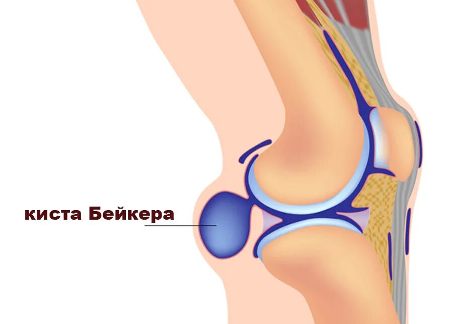 Болит под коленкой. Киста Бейкера коленного сустава анатомия. Бурсит коленного сустава подколенной ямки. Синовиома тазобедренного сустава.