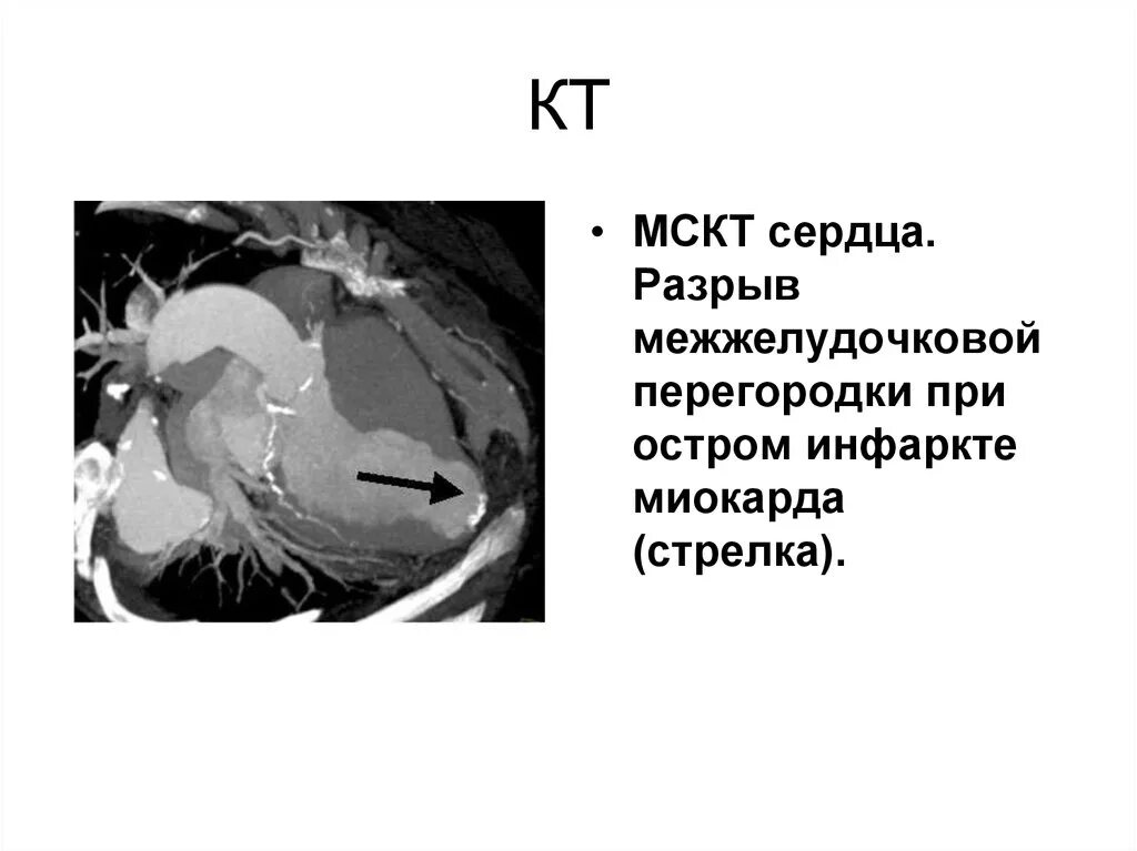 Инфаркт миокарда межжелудочковой перегородки. Инфаркт миокарда межжелудочковой перегородки. Аневризма верхушки эхокардиография. Причины развития миокардита. Компьютерная томография инфаркта миокарда.