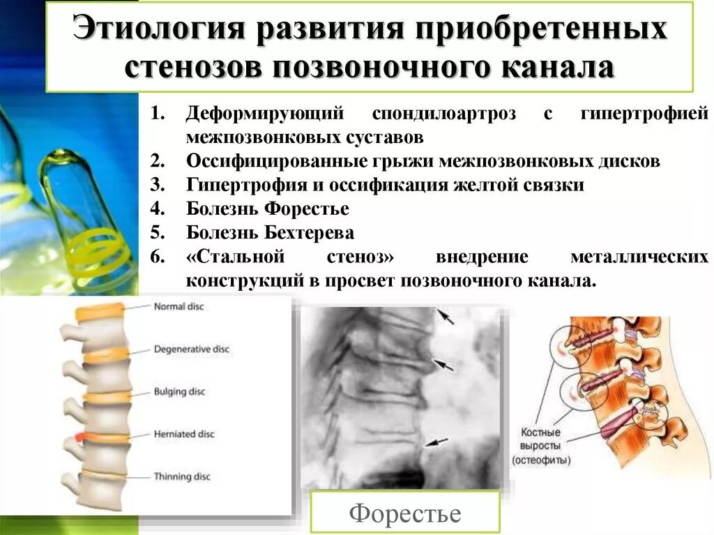 Поясничный абсолютный стеноз