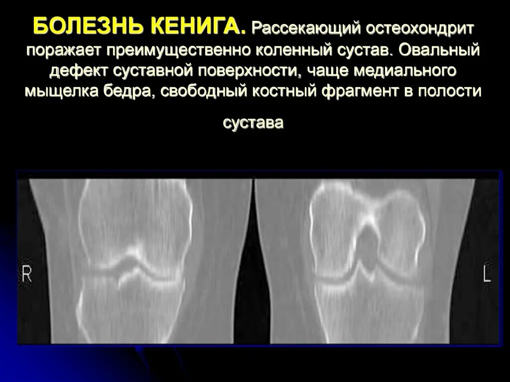 Болезнь Кенига коленного сустава. Рассекающий остеохондрит надколенника рентген. Остеохондропатия надколенника (болезнь Синдинга-Ларсена). Болезнь Кёнига рассекающий остеохондрит рентген.