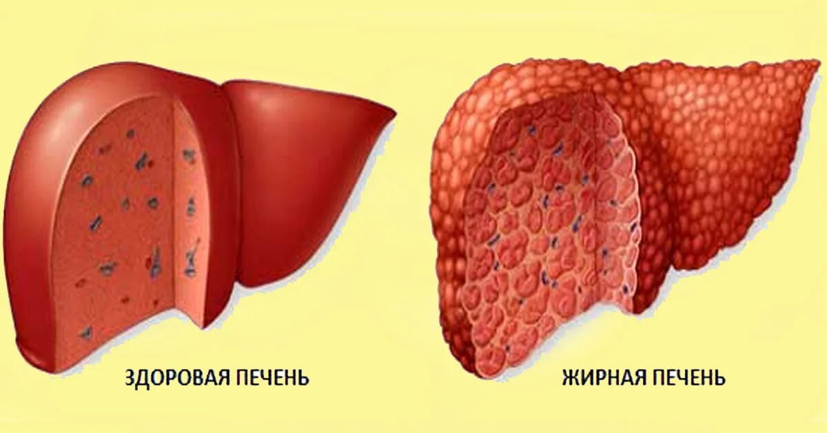 жировой гепатоз печени. жировой гепатоз (стеатоз) печени. жировой гепатоз печени. жировая инфильтрация печени. жировом гепатозе печени симптомы.