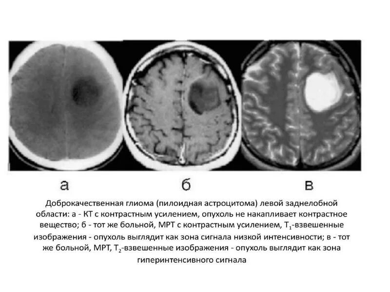 Доброкачественная опухоль головного мозга сколько живут. Доброкачественные опухоли головного мозга кт. Доброкачественная астроцитома мрт. Опухоль головного глиома кт. Глиома головного мозга кт.