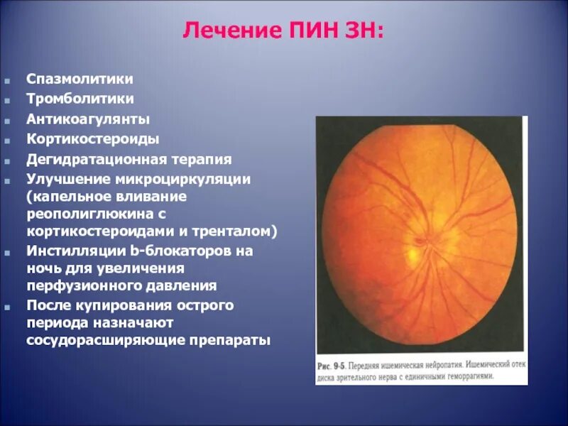 Нисходящая атрофия. Передняя ишемическая нейропатия зрительного. Передней ишемической нейропатии зрительного нерва. Оптикопатия зрительного нерва. Передняя ишемическая оптиконейропатия зрительный нерв.