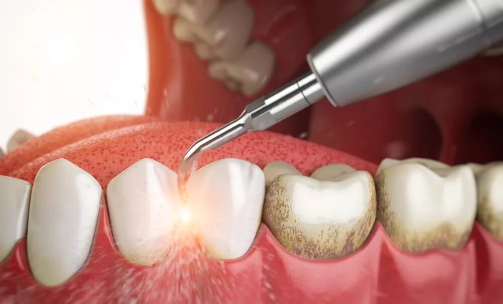 Профгигиена (ультразвук + Air-Flow). Пришеечный зубной камень. Поддесневой зубной налет. Поддесневые отложения зубной камень. Почему сильно зуб