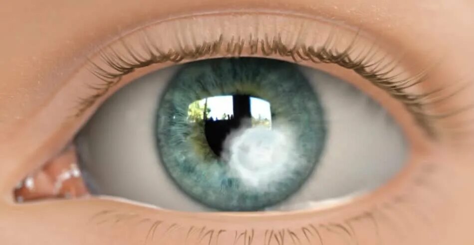 роговица помутнела