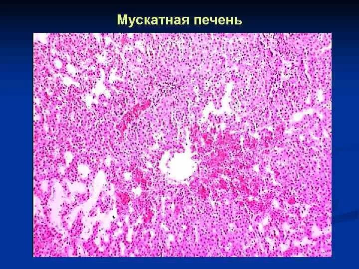 Хроническое венозное полнокровие печени микропрепарат. Мускатная печень патанатомия макропрепарат. Мускатный цирроз печени микропрепарат. Мускатная печень микропрепарат патанатомия. Печень микропрепарат описание