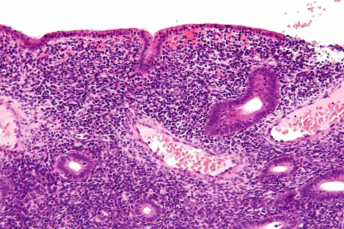 Острый эндометрит гистология. Эндометрит патологическая анатомия. Гнойный послеродовой эндометрит микропрепарат. Гистология Гнойный эндометрит. Эндометрий базальный слой