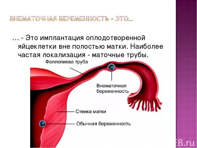 Оплодотворение в полости матки. Имплантация оплодотворенной яйцеклетки. Локализация маточных труб. Яйцеклетка в матке.