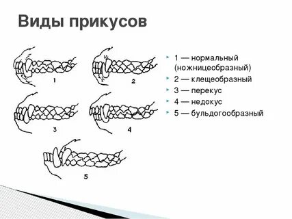 Схемы прикусов
