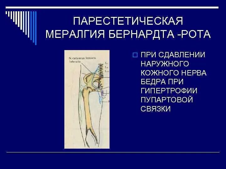 Наружная невропатия. Латеральный наружный кожный нерв бедра. Невропатия наружного кожного нерва бедра. Парестетическая мералгия. Синдром наружного кожного нерва бедра.