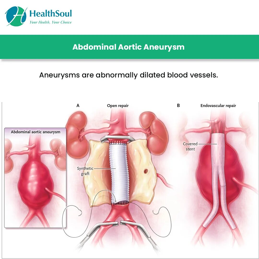Аортик аневризм. Аневризма брюшной аорты. Шейка аневризмы брюшной аорты. Разрыв аневризмы брюшной аорты. Аорта брюшной полости операция