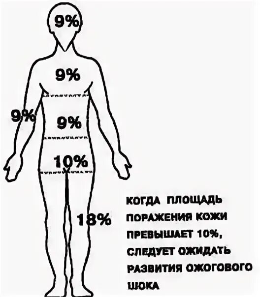 Ожоги проценты поражения. Площадь ожоговой поверхности.