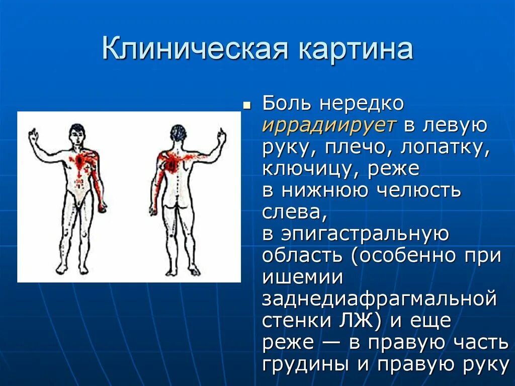 Иррадиация боли в левую руку. Иррадиация боли в левое плечо. Иррадиация боли в правую руку. Боль иррадиирует в правую лопатку. Иррадиация в левую лопатку