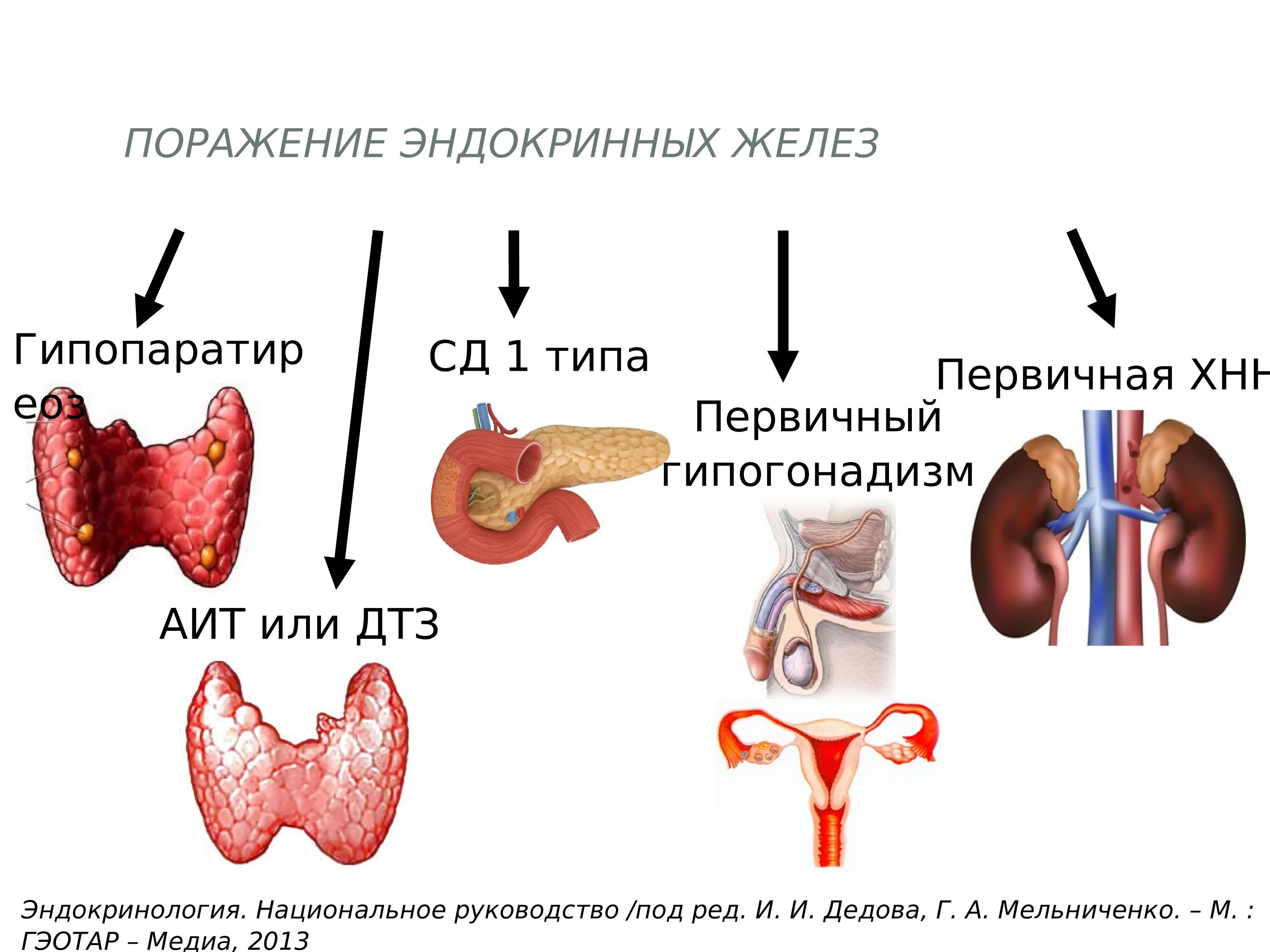 Синдром аутоиммунной полиэндокринопатии. Аутоиммунный полигландулярный синдром. Патология эндокринных желез. Заболевания эндокринных органов