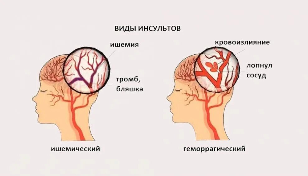 Заболевания ишемического инсульта. Инсульт. Микроинсульт головного мозга. Формы геморрагического инсульта. Развитие инсульта.