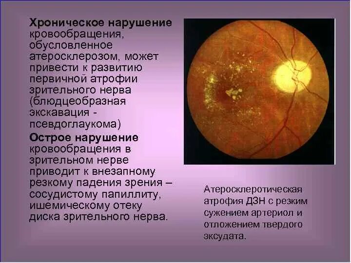 Хронические заболевания зрения. Изменения на глазном дне. Глазное дно при атеросклерозе. Исследование глазного дна при атеросклерозе. Изменение органов зрения при атеросклерозе.