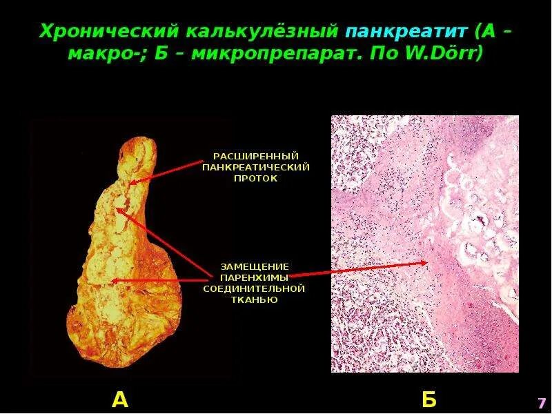 Жировые изменения печени и поджелудочной железы. Хронический панкреатит макропрепарат. Хронический панкреатит патанатомия. Хронический панкреатит патанатомия препарат. Некроз поджелудочной железы макропрепарат.