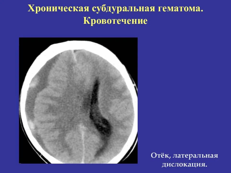 Подострая субдуральная гематома на кт. Хроническая субдуральная гематома на кт. Субдуральная гематома 250мл. Субдуральная гематома лечение