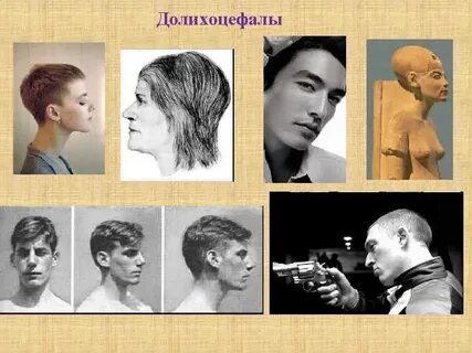 Долихоцефалия