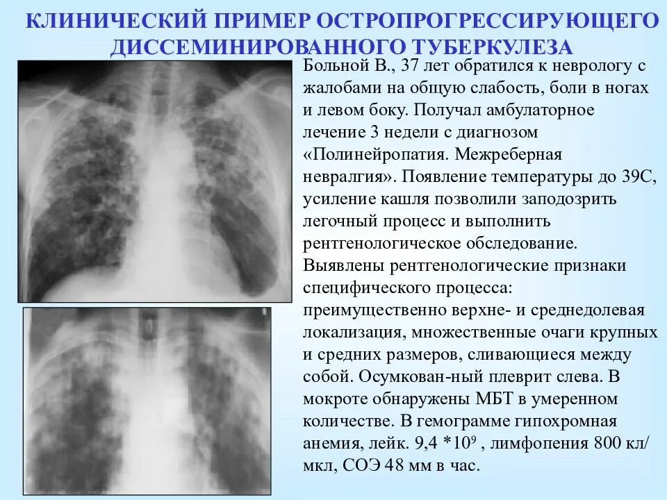 Туберкулез симптомы формы. Диссеминированный туберкулез симптомы. диссеминированный туберкулез на рентгенограмме. туберкулёз лёгких у взрослых. симптомы больного туберкулезом легких.