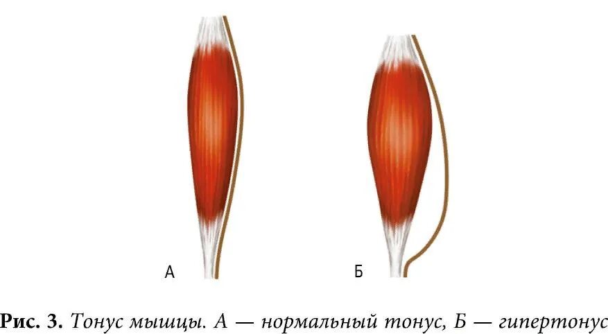 Повышение мышечного тонуса skinlift ru. Мышца в гипертонусе. Нормотонус мышц. Гипертонус мышц. Нормальный тонус мышц.