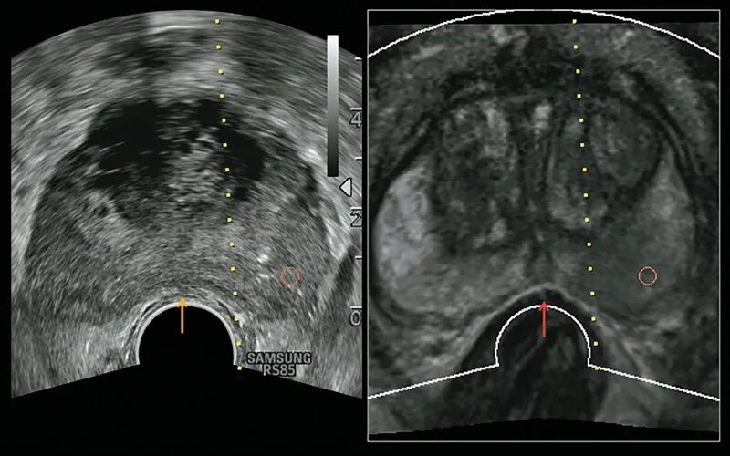 Аденома предстательной железы на УЗИ. Ложе предстательной железы. УЗИ простаты спереди. Аппарат для УЗИ простаты. Трузи предстательной железы как делают