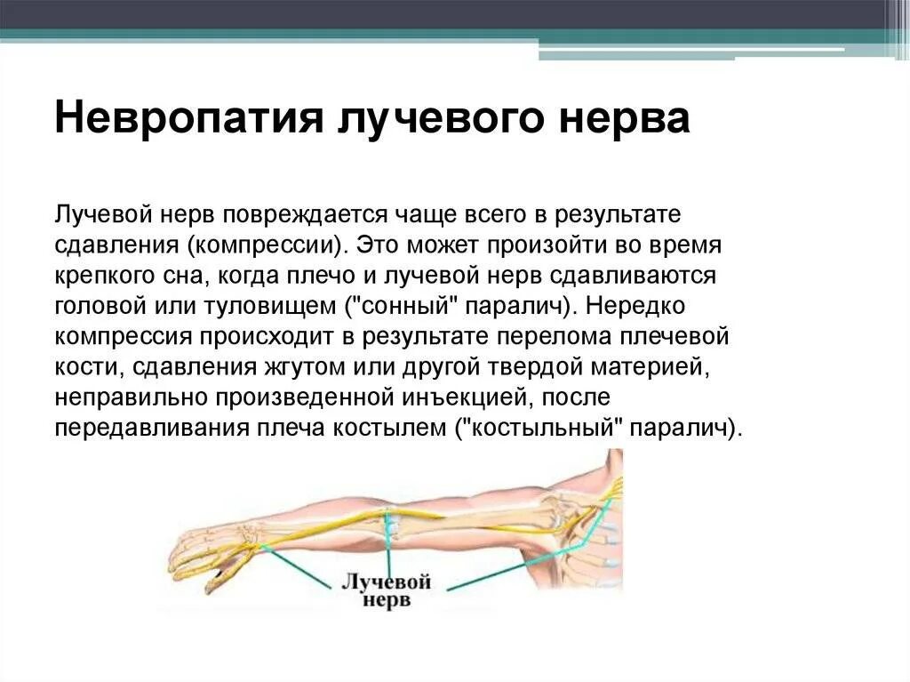 Поражение нервов руки. Электростимуляция неврит лучевого нерва. Признаки невропатии лучевого нерва. Симптомы нейропатии лучевого нерва. Невропатия лучевого нерва, нейропатия лучевого нерва.