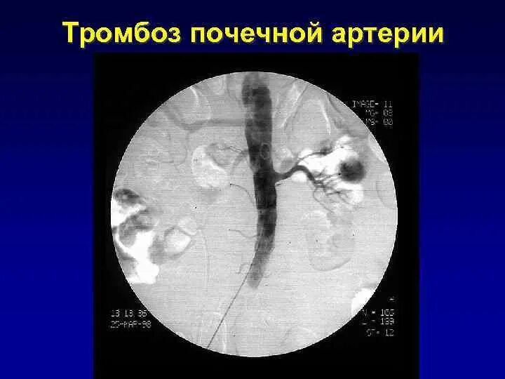 Тромбоэмболия почечных артерий. Ангиография тромбоз почечной артерии. Тромбоз печеночной артерии кт. Тромбоз почечной вены кт. Тромб в печени