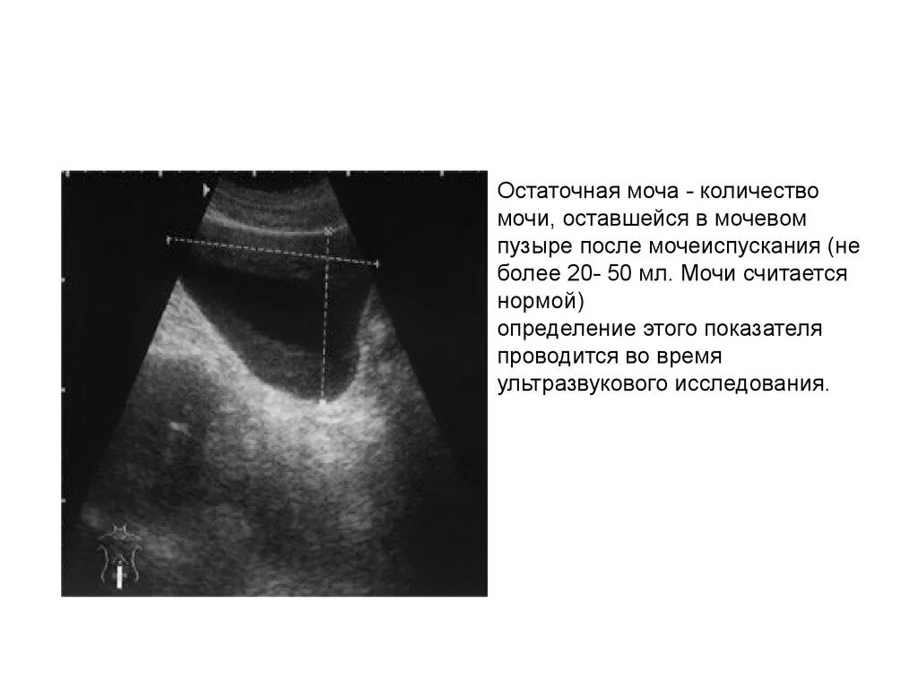 Остаток мочи у мужчин. Объем мочевого пузыря на УЗИ норма. УЗИ мочевого пузыря остаточная моча. УЗИ мочевого пузыря показатели в норме. Объем мочевого пузыря в норме по УЗИ.