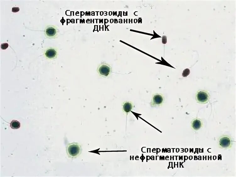 Фрагментация днк методы. Оценка фрагментации ДНК сперматозоидов расшифровка. Спермограмма с ДНК фрагментацией. Анализ ДНК фрагментации спермограммы. Фрагментация ДНК анализ.