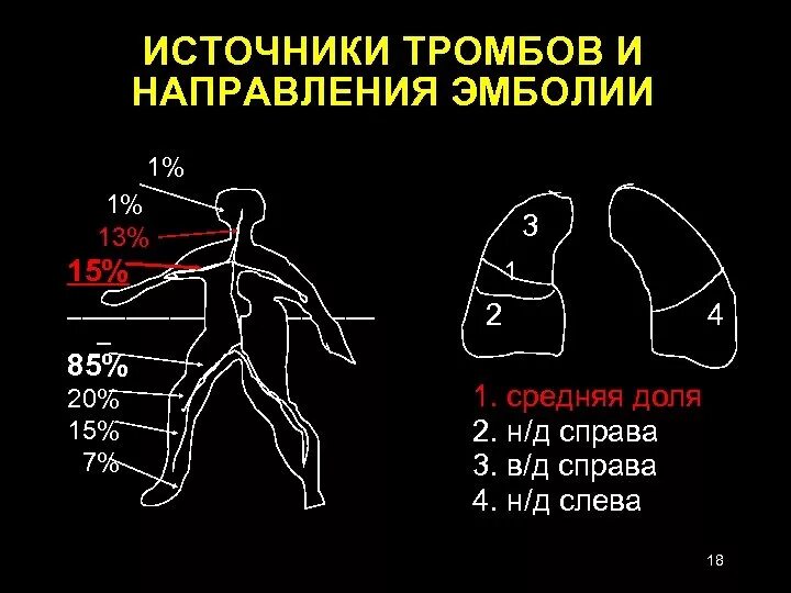 Тромбоэмболия легочной артерии экг. Источники тромбоэмболии. Тэла на ЭКГ. Тромбоэмболия на ЭКГ. Тромбоэмболия легочной артерии на ЭКГ.