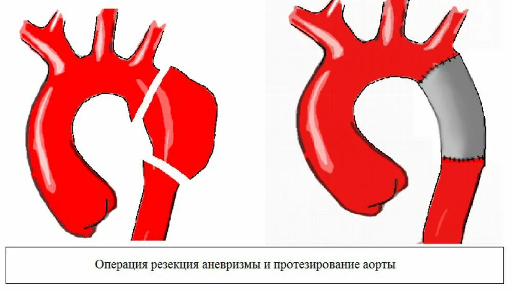 Аневризма восходящей аорты операция. Операции при расслаивающей аневризме аорты. Операции коарктации аорты. Операции при расслаивающей аневризме дуги аорты. Сосудистый протез для аорты.