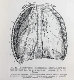 Эмпиема легкого