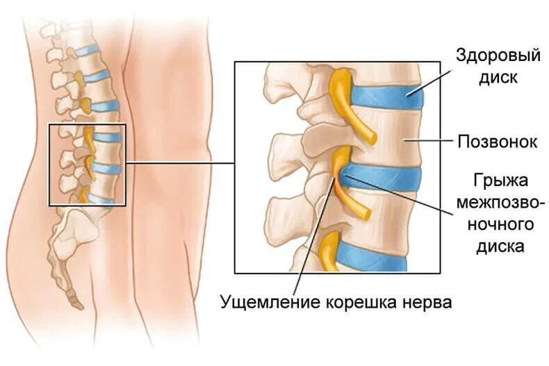 Корешковое защемление в пояснице. Межпозвоночная грыжа грыжа поясничного отдела. Грыжа позвонка поясничного отдела. Грыжа позвоночника защемление нерва. Межпозвоночные диски пояснично крестцового отдела.