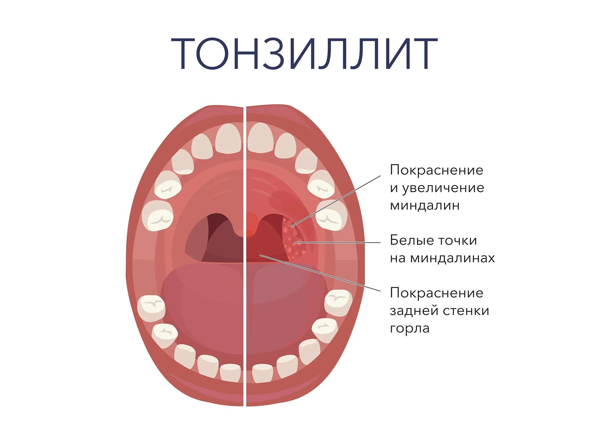 Неприятный вкус в горле. Хронический тонзиллит гнойные пробки. Хронический тонзиллитсимпомы. Воспаление острого хронического тонзиллита. Хронический тонзиллит налет.