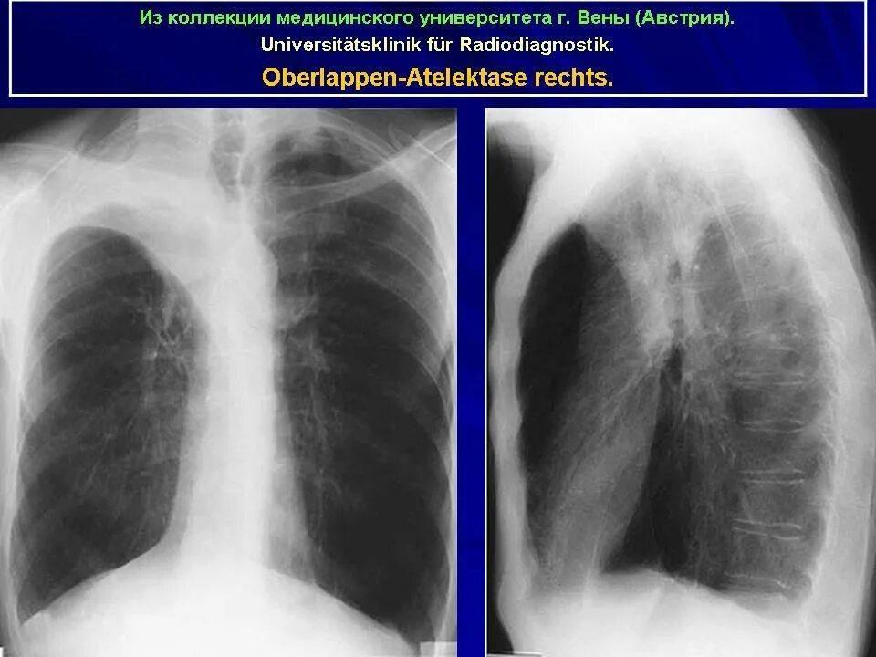 Спадение бронха