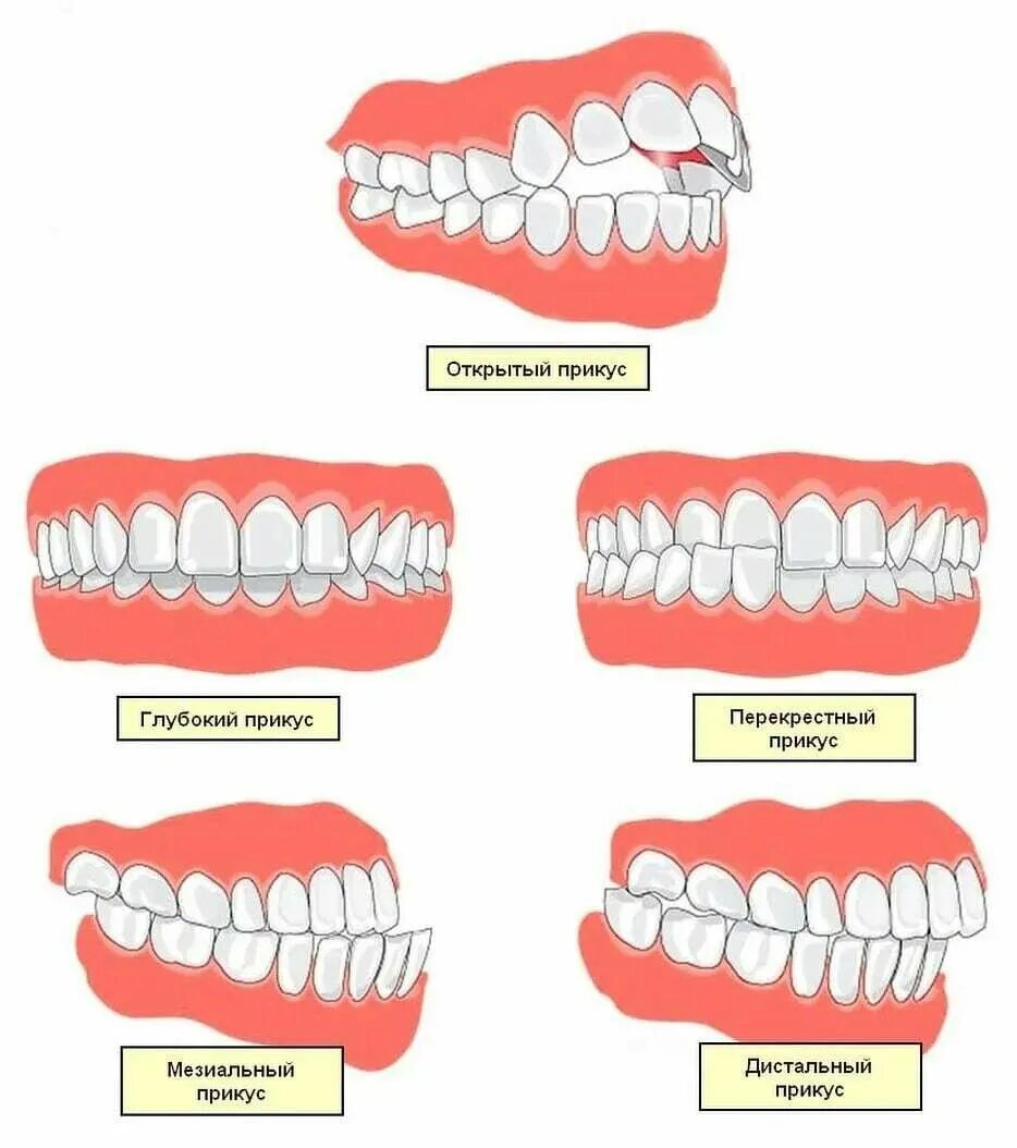 Почему зубы отличаются между собой у разных. Правильный прикус вид сбоку. Перекрестный прикус на нижней челюсти. Правильный прикус зубов смыкание зубов. Перекрестный прикус верхней челюсти.