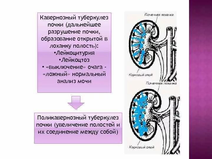 Кавернозный туберкулез почки. Кавернозный туберкулез почки макропрепарат. Фтизиатрия туберкулёз почек. Критерии заболевания туберкулезом почки. Распад почки