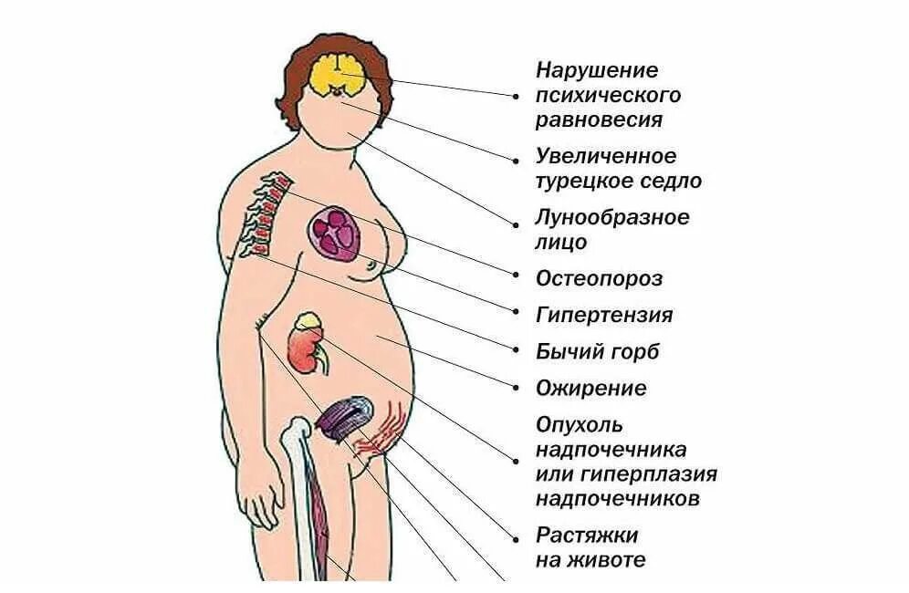 Болят ли надпочечники. Клинические симптомы болезни Иценко-Кушинга. .Болезнь Иценко Кушинга болезнь Кушинга. Синдром Иценко Кушинга проявления. Синдром Иценко Кушинга симптомы.