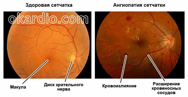 Гипертоническая ангиопатия и ретинопатия. Гипертоническая ретинопатия глазное дно. Ангиопатия сетчатки глазное дно. Ангиопатия сосудов глазного дна. Ангиопатия сосудов сетчатки что это