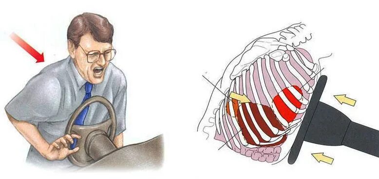 Сотрясение руки. Сдавление грудной клетки перелом ребер. Травматическая асфиксия грудной клетки. Сдавление грудной клетки травма. Закрытая травма грудной клетки перелом ребер.