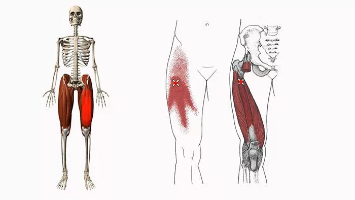 Триггерные точки мышц таза. Квадратная мышца бедра триггерные точки. Триггерная точка передней мышцы бедра. Гребенчатая мышца бедра триггерные точки. Сильно болит бедро ноги