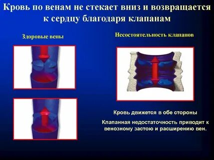 Недостаточность венозного клапана