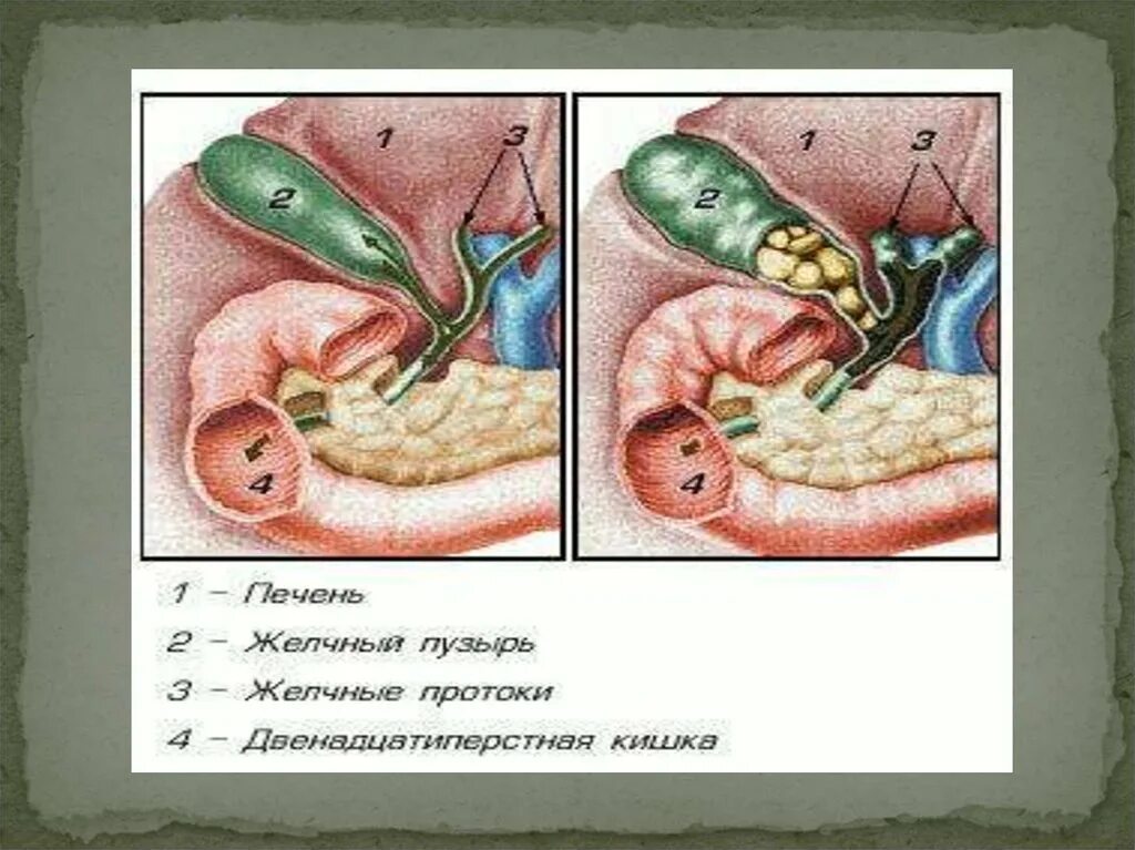 Хронические заболевания холецистит. Хронический холецистит. Желчекаменная болезнь.