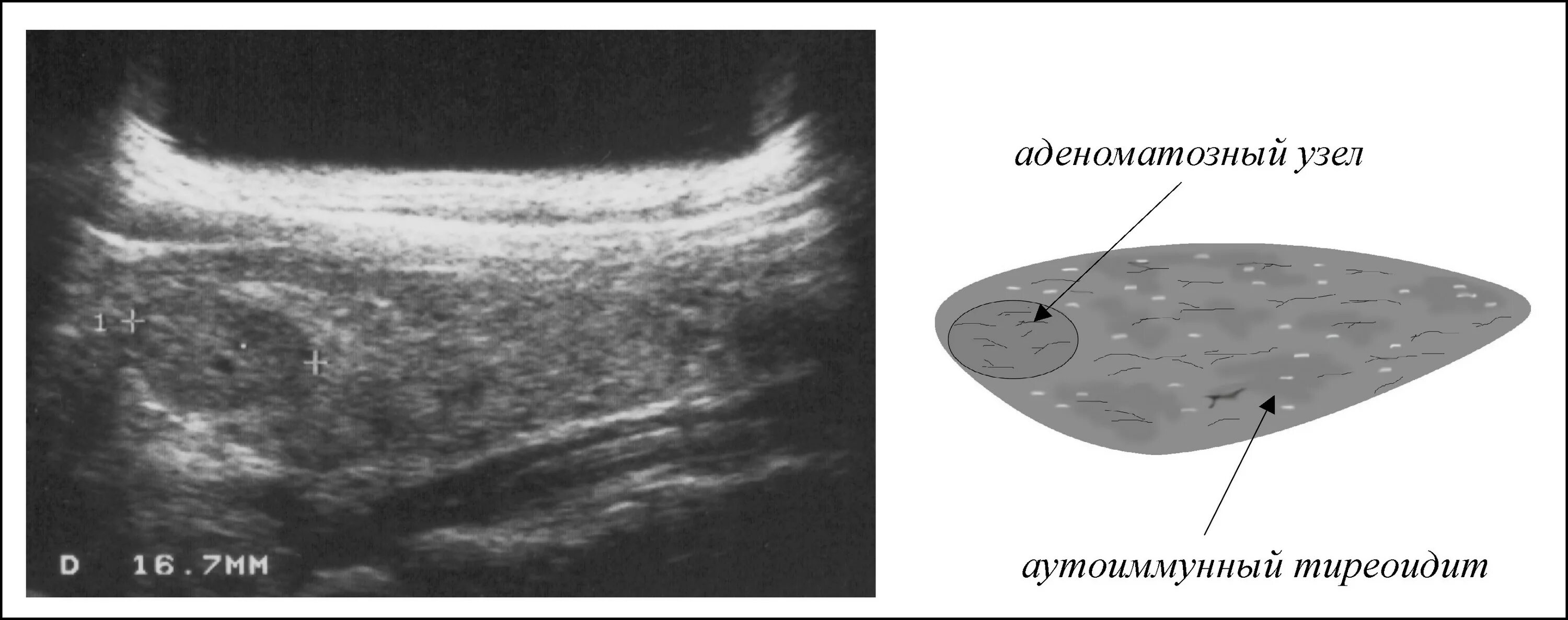 Узел в простате. УЗИ щитовидной железы гипоэхогенное образование. Гиперэхогенный узел в щитовидной железе УЗИ. Губчатый узел щитовидной железы на УЗИ. Гипоэхогенный узел щитовидной железы на УЗИ.